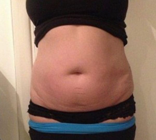 lipofirm treatment before