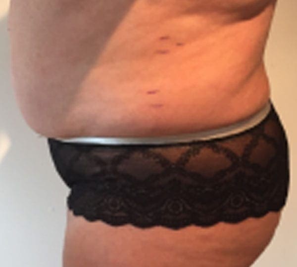 lipofirm before