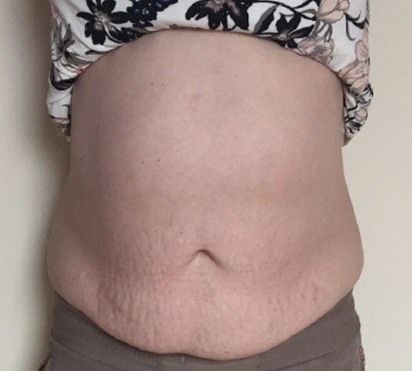 body contouring before