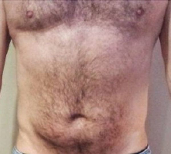 body contouring after