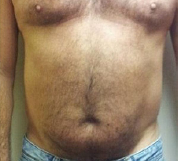 body contouring before