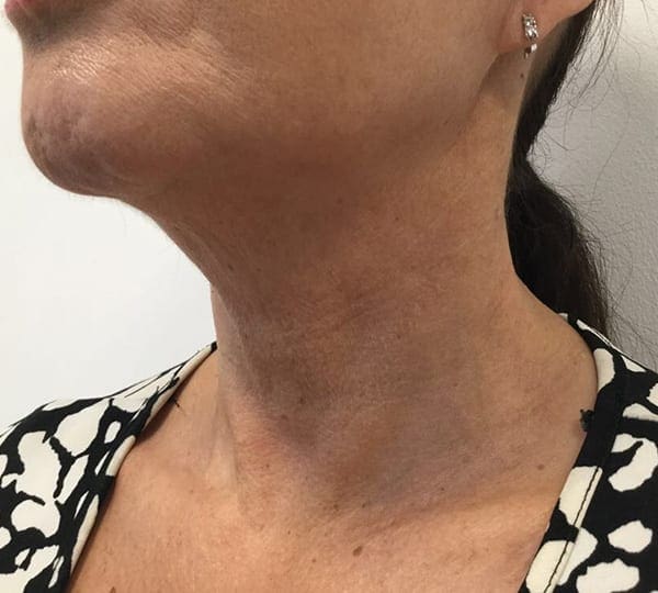 mesoteraphy treatment after