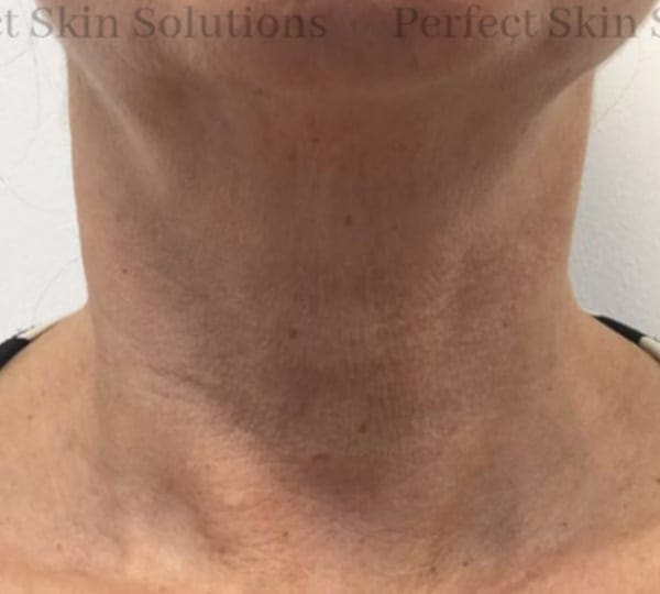 mesotherapy treatment after