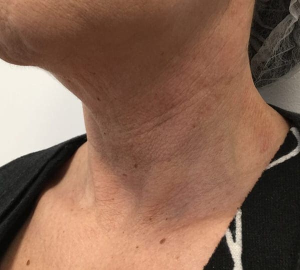 mesotheraphy treatment before