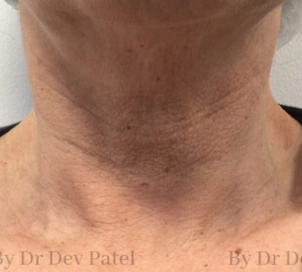 mesotherapy treatment before