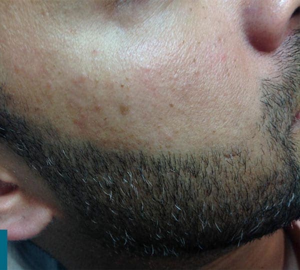 mole removal treatment after