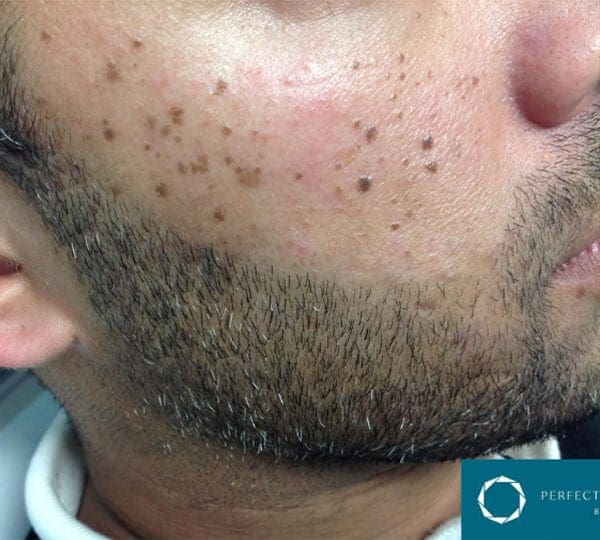 mole removal treatment before