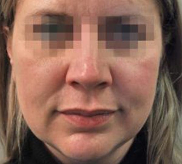 profhilo treatment before