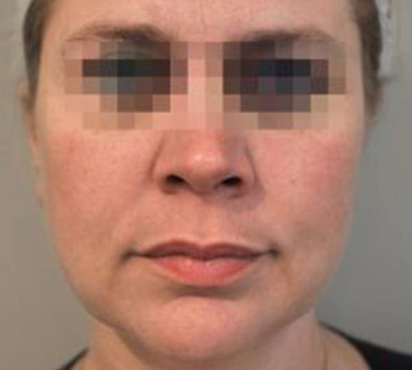 profhilo treatment after