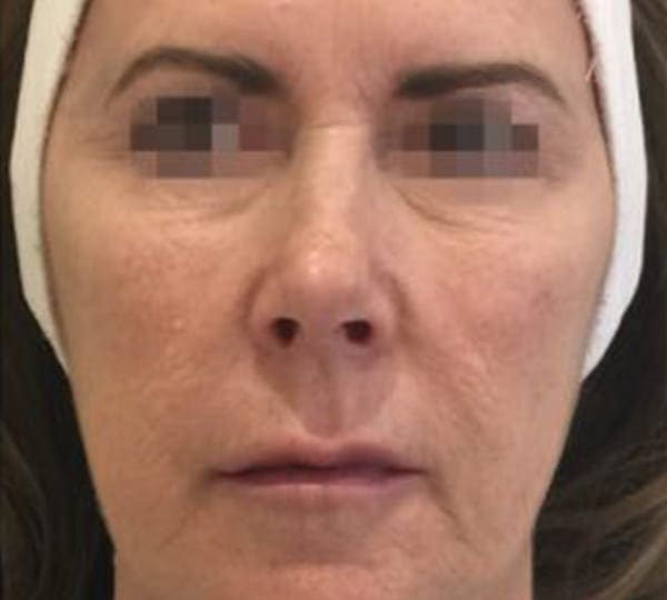 profhilo treatment after