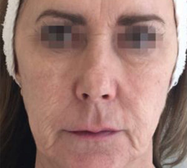 profhilo treatment before