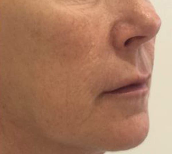 profhilo treatment after