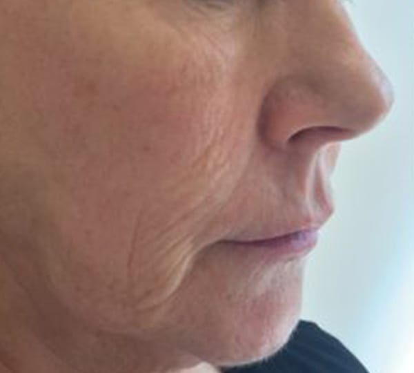 profhilo treatment before