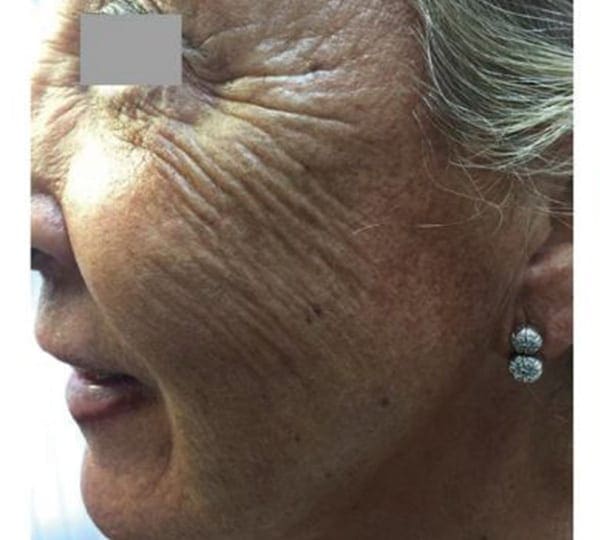 skin booster treatment before