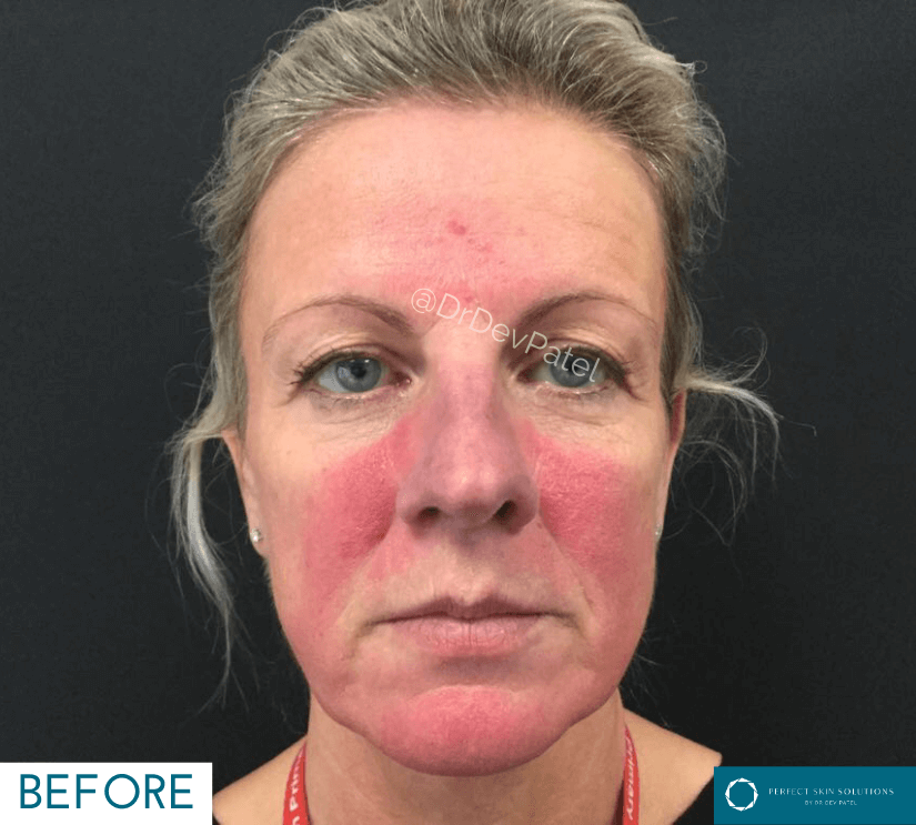 intense pulse light treatment before