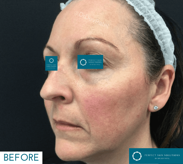 tear trough filler before