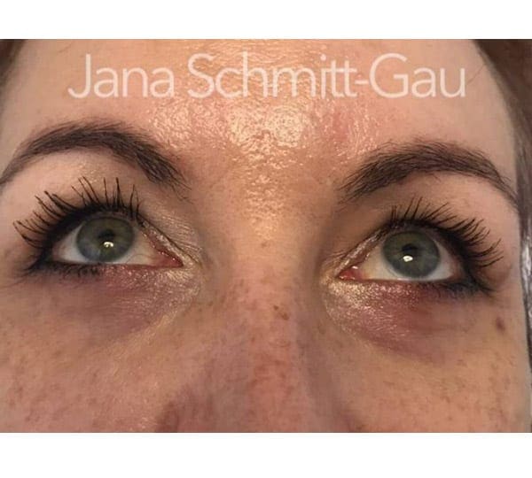 sunekos treatment before