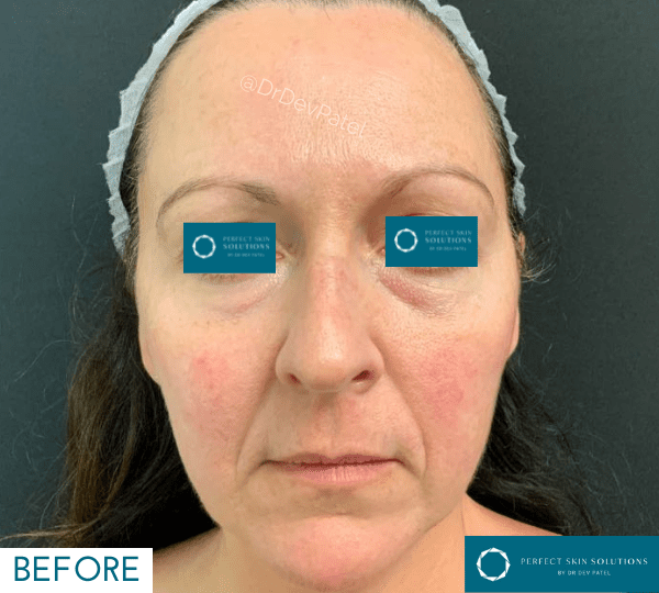 tear trough filler before