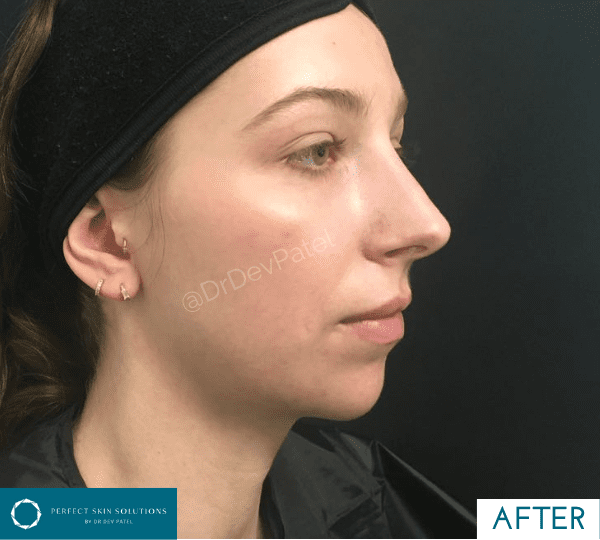 chin filler treatment after