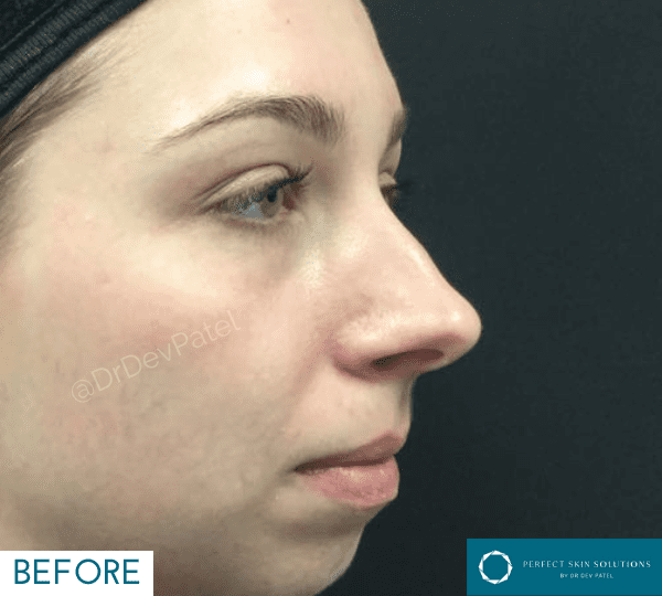 dermal filler before