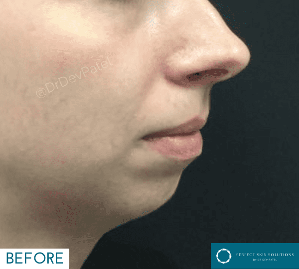 chin filler treatment before