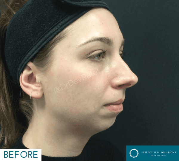 chin filler treatment before