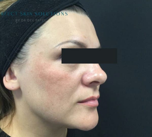 melasma protocol before