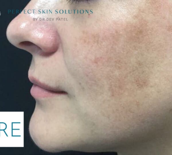 melasma protocol after