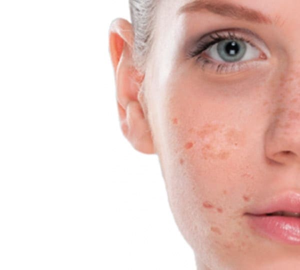 melasma protocol before