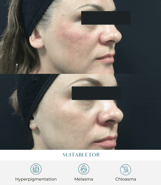 Melasma Protocol