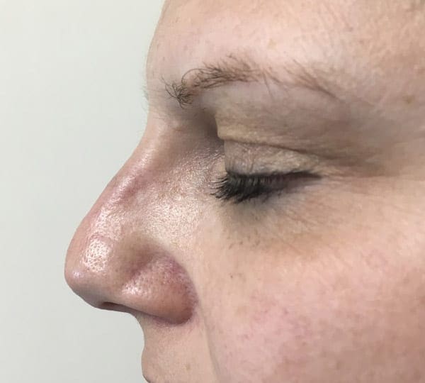 nose filler after