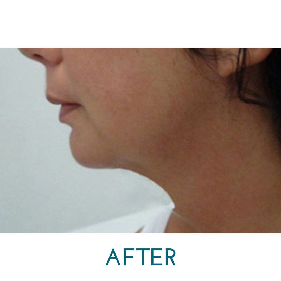EndoLift offers a remarkable, non-surgical alternative to the traditional surgical facelift (or necklift), as well as options for body contouring.