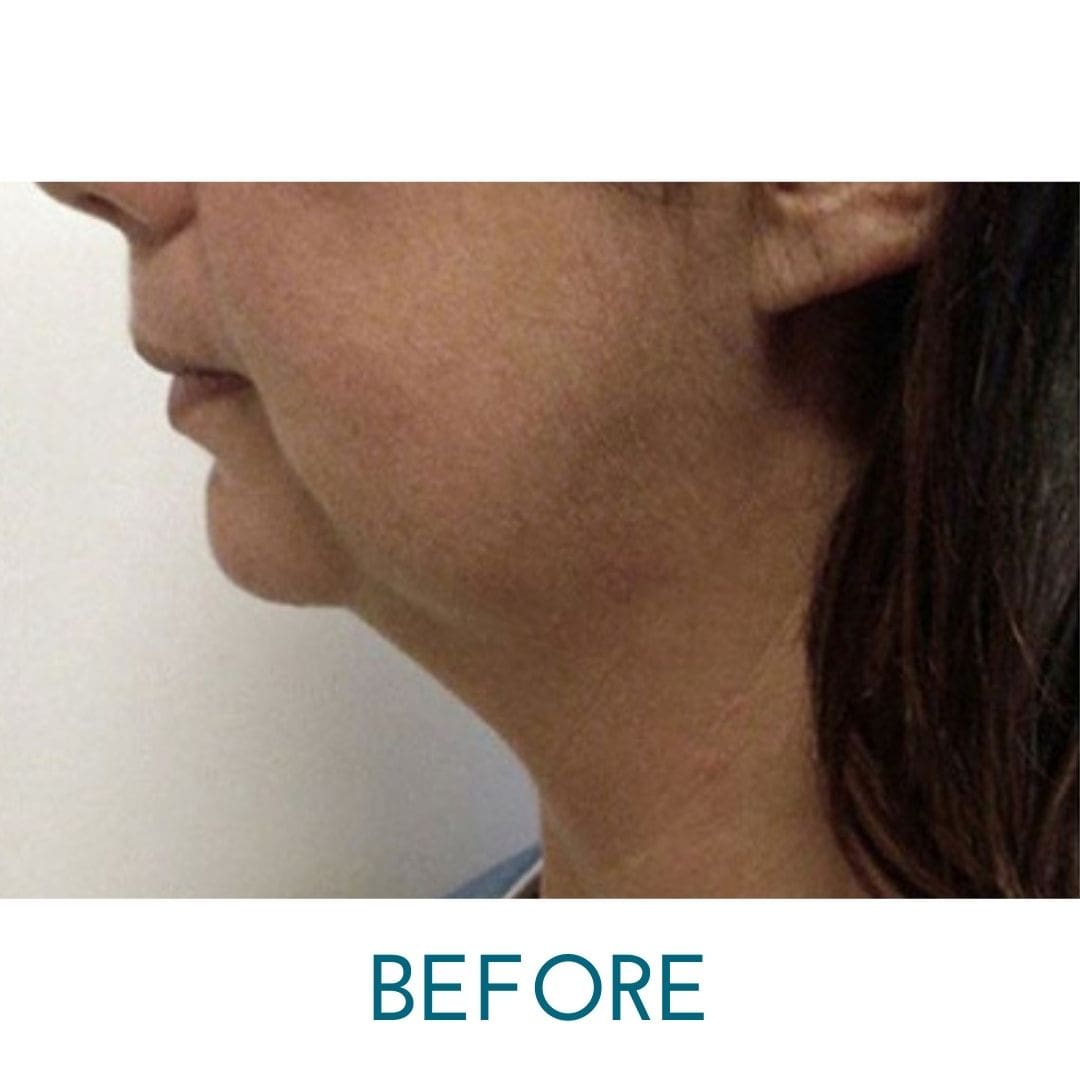 EndoLift offers a remarkable, non-surgical alternative to the traditional surgical facelift (or necklift), as well as options for body contouring.