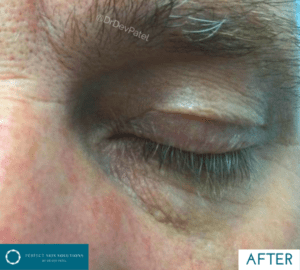 skin tag removal after