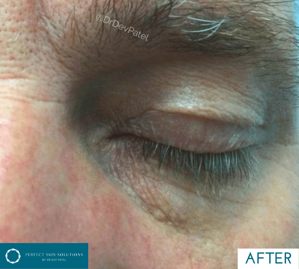 skin tag removal after