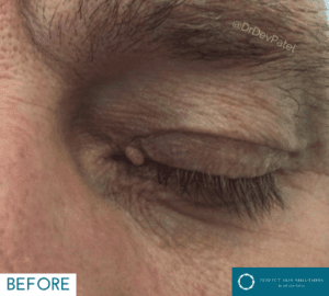 skin tag removal before