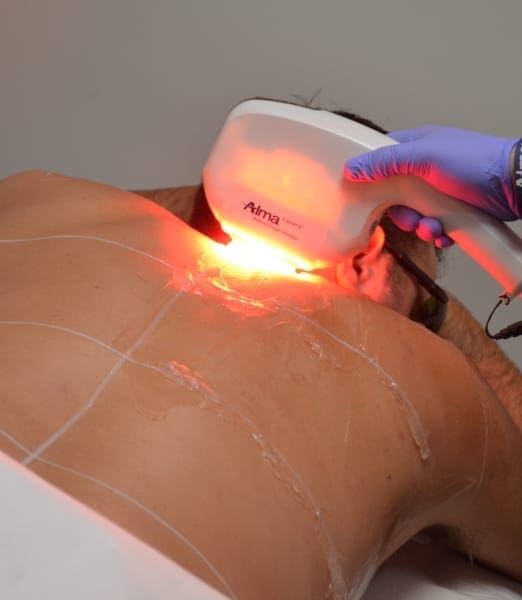 DITCHING THE RAZOR FOR THE LASER!