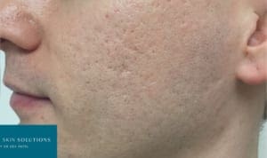 acne scarring after picture