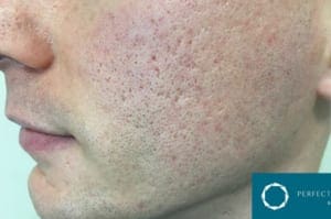 acne scarring before picture