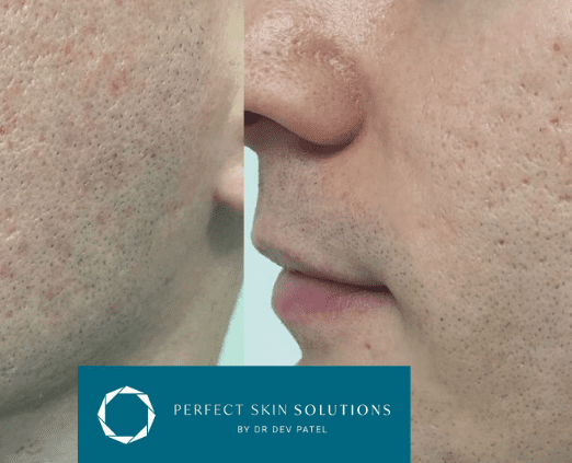 Facial for Scars: Acne Scar Treatments at Perfect Skin Solutions