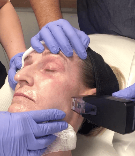 Dr Dev Patel and Inmode’s Morpheus8 features in Marie Claire