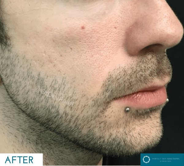 tear trough filler - after