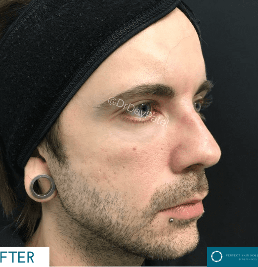 Jawline Fillers Men: Achieve a Strong, Defined Jawline with Dermal Filler Treatments