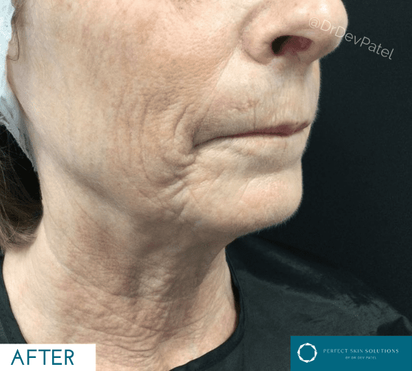 Josephine before Morpheus8