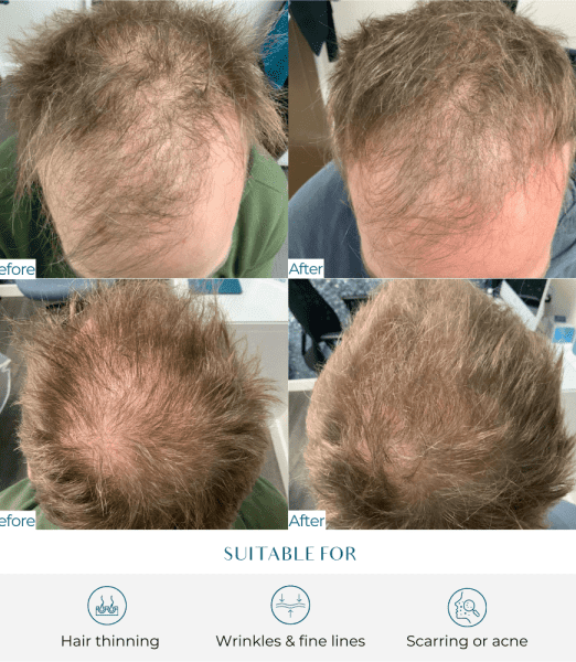 Discover the Power of Exosome Skin Booster at Perfect Skin Solutions