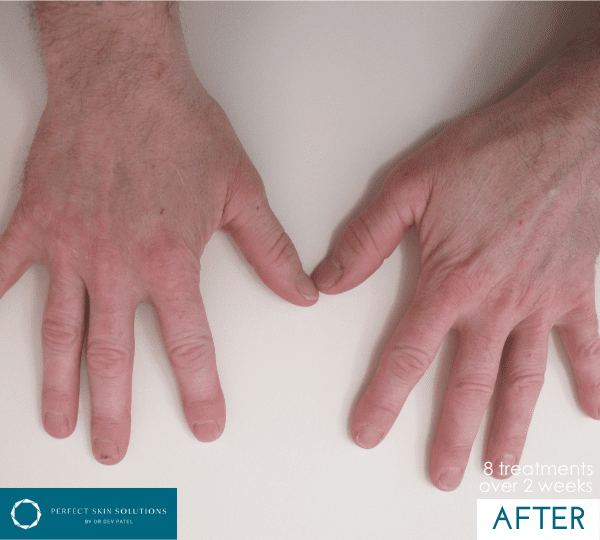 dermalux treatment after