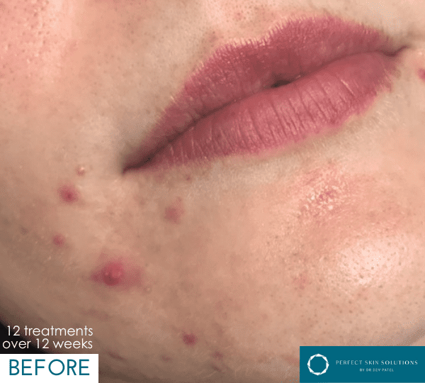 dermalux treatment before