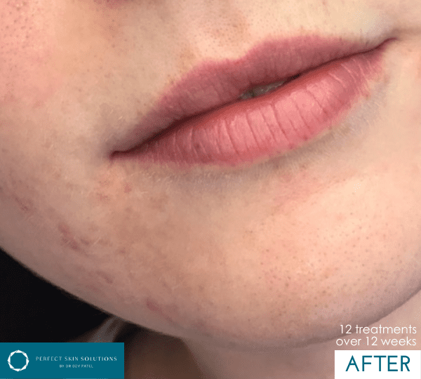 dermalux treatment after