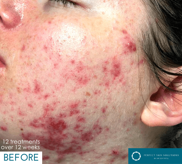 dermalux treatment before