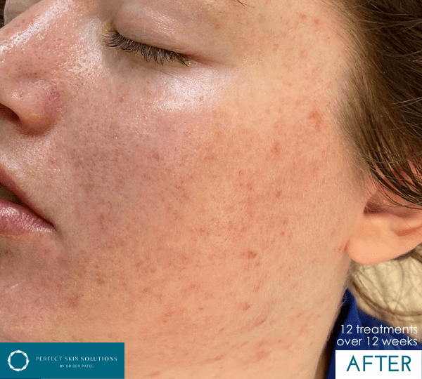 dermalux treatment after